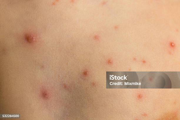 Varicella Skin Texture Stock Photo - Download Image Now - Pimple, Complaining, Shingles