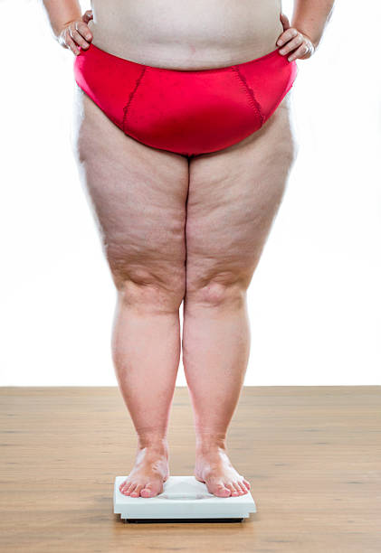 istock women legs with overweight 532266088