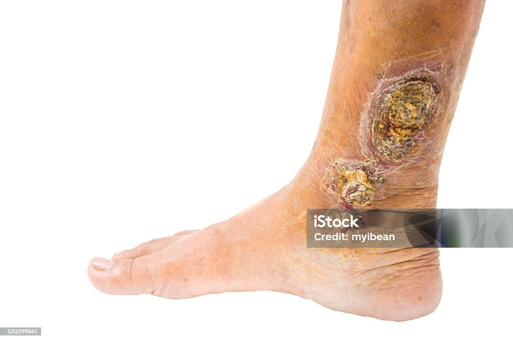 chronic venous leg ulcer Wound Stock Photo