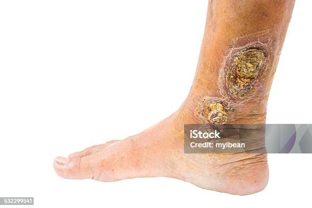 Chronic Venous Leg Ulcer Stock Photo - Download Image Now - Wound, Ulcer, Human Leg