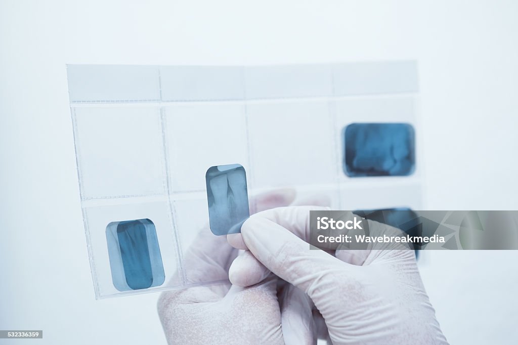 Gloved hands holding teeth x-ray Close up of gloved hands holding teeth x-ray 2015 Stock Photo