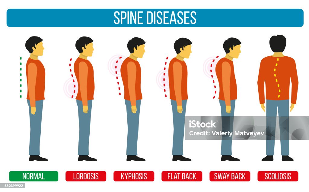 Body posture defect. Vector infographics of spine diseases Body posture defect. Vector infographics of spine diseases. Scoliosis and lordosis medical diagrams. Spine backbone, spine diagnosis, diagnostic spine symptom, design spine diseases illustration Diagram stock vector