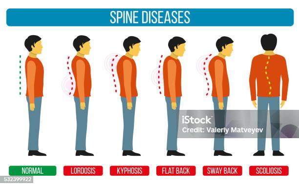 Body Posture Defect Vector Infographics Of Spine Diseases Stock Illustration - Download Image Now