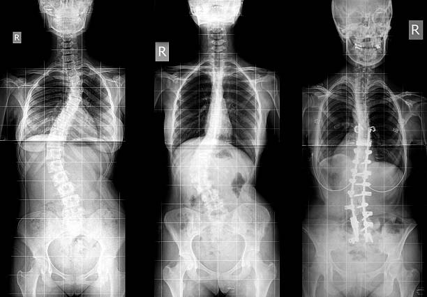 scoliose x-ray image avec implant - scoliosis photos et images de collection