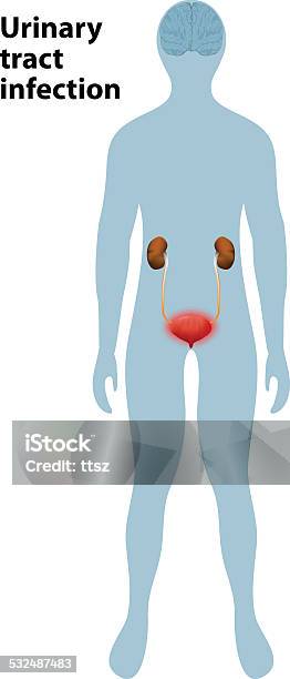 Cystitis Drawing Urinary Tract Infection Cystitis Stock Illustration - Download Image ...