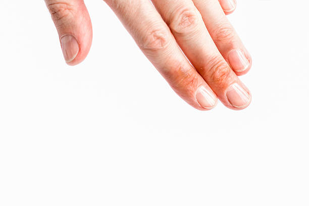 istock Isolated womans hand with burns on fingers 532575876
