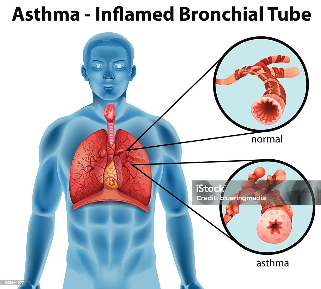 Asma-se exasperaram brônquica metrô - Vetor de Asmático royalty-free