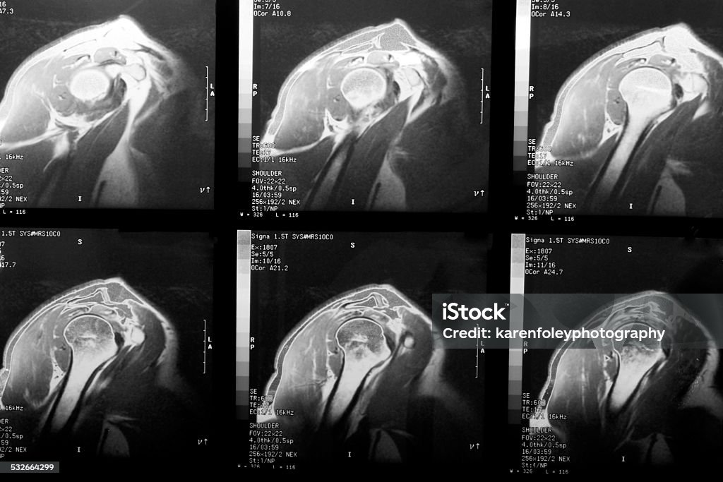 MRI of Rotator Cuff MRI images of a shoulder blade and rotator cuff 2015 Stock Photo