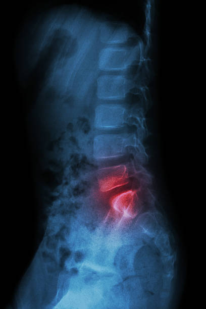 da coluna lombar de criança e a inflamação no da coluna lombar - x ray image x ray back low - fotografias e filmes do acervo