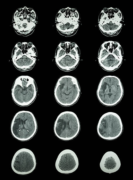 badanie tk (tomografia komputerowa), show cerebral zawał mózgu - human nervous system cat scan brain doctor zdjęcia i obrazy z banku zdjęć