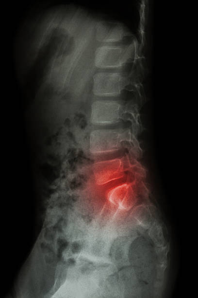 columna lumbar de niño y la inflamación en la columna lumbar - haunch fotografías e imágenes de stock