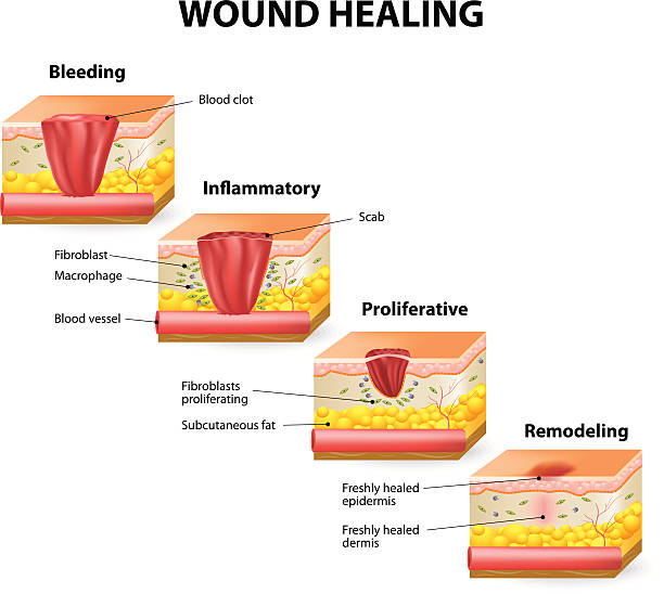 wound healing Phases of the wound healing process. Hemostasis, Inflammatory, Proliferative, Maturation and remodeling phase recovery stock illustrations