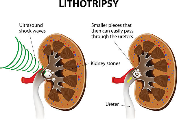 illustrazioni stock, clip art, cartoni animati e icone di tendenza di litotripsia - kidney stone