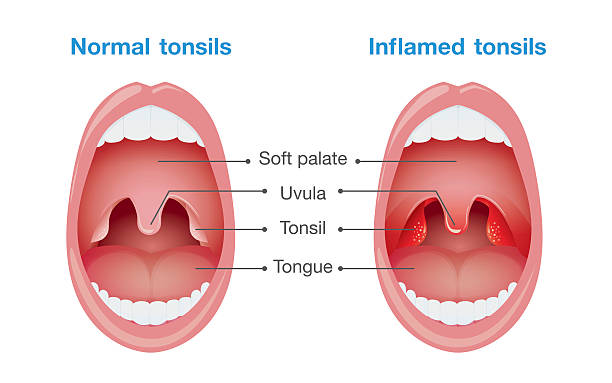 Normal tonsils and inflamed tonsils. Comparison between normal tonsils and inflamed tonsils. This illustration about health care and medical. human neck illustrations stock illustrations