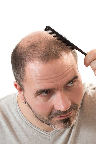 istock man alopecia baldness hair loss isolated 533339840