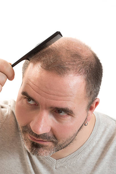 istock man alopecia baldness hair loss isolated 533340384