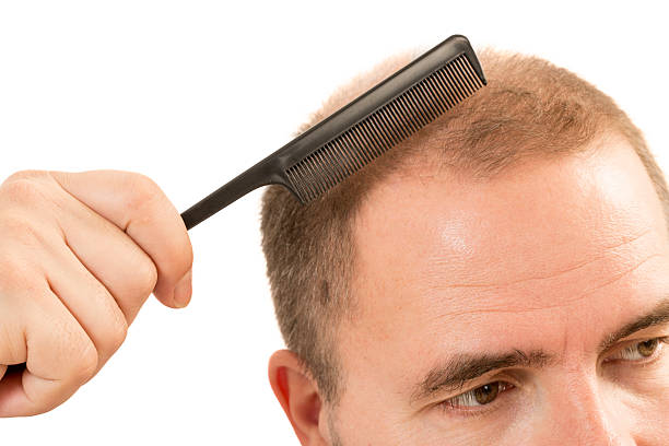 istock man alopecia baldness hair loss isolated 533342430