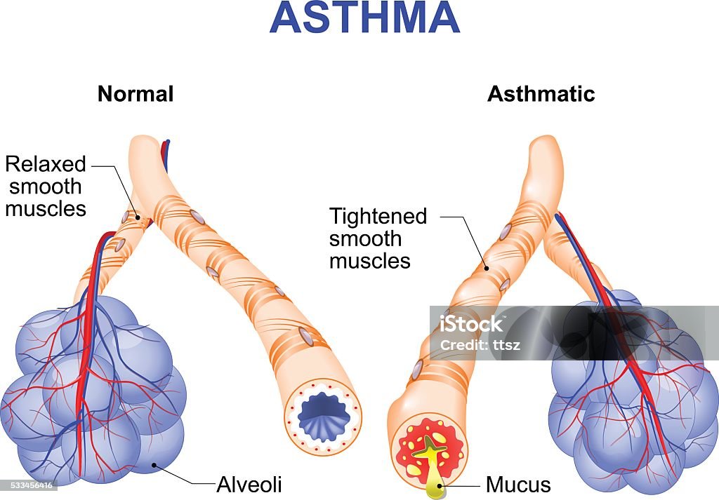 inflamation of the bronchus causing asthma Asthma is a chronic inflammatory disease of the airways that is characterized by narrowing of the airways and dyspnea, wheezing, and coughing. Asthmatic stock vector