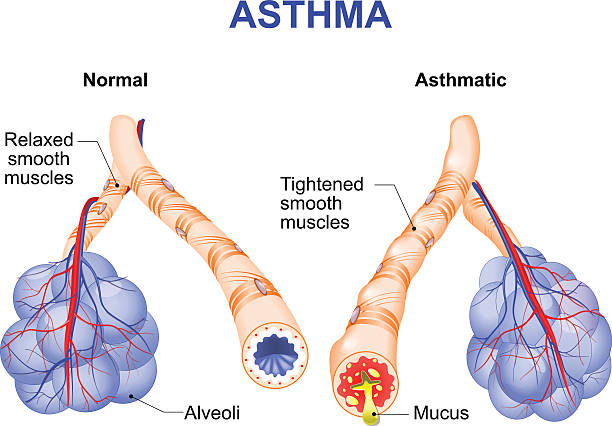 inflamation of the bronchus causing asthma Asthma is a chronic inflammatory disease of the airways that is characterized by narrowing of the airways and dyspnea, wheezing, and coughing. bronchiole stock illustrations