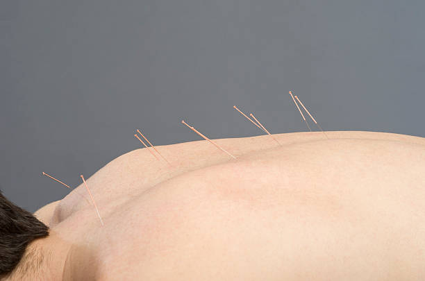 istock Chinese medicine doing acupuncture to man patient 533459428
