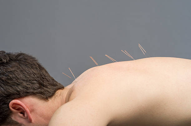 istock Chinese medicine doing acupuncture to man patient 533459638