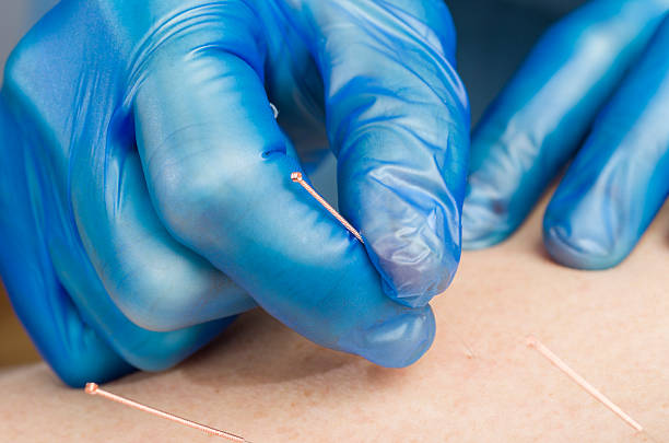 istock Chinese medicine doing acupuncture to man patient 533459904