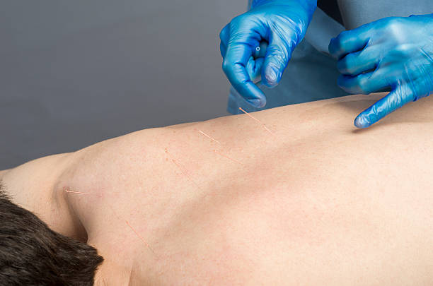 istock Chinese medicine doing acupuncture to man patient 533459992