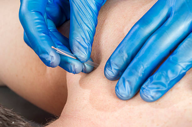 istock Chinese medicine doing acupuncture to man patient 533460550