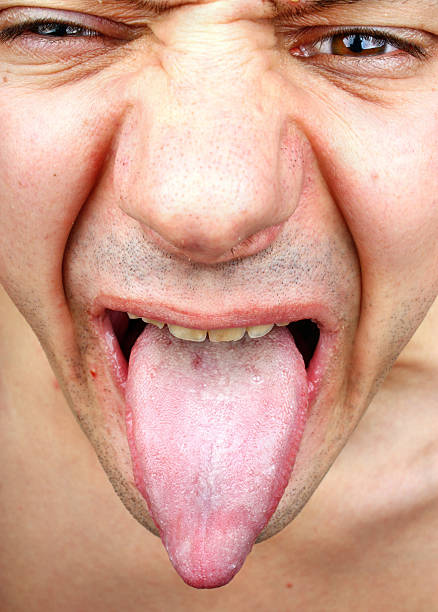 istock Infection tongue 533473979