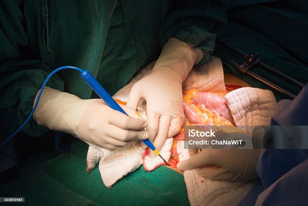explore laparotomy Laparotomy is the general medical term for a surgery performed on the abdomen using the traditional full-size incision 2015 Stock Photo