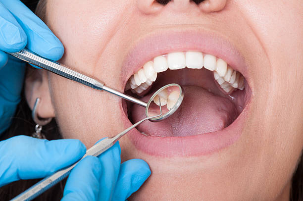zahnarzt tools und den mund offen mit wunderschönen zähnen - zahnkaries stock-fotos und bilder