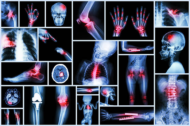 x-레이 여러장 휴머니즘 왜고너의 장기 & 정형외과 수술 & 여러 질병 - human lung x ray image x ray human spine 뉴스 사진 이미지