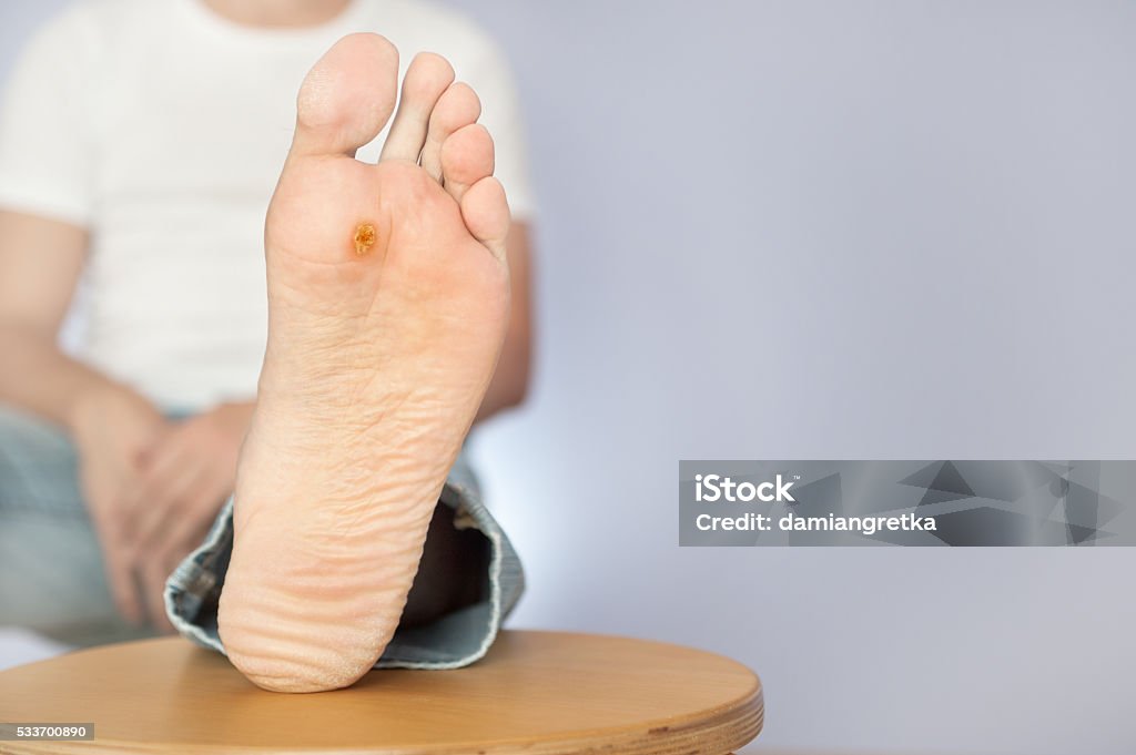 medical consultation at the removal of wart Wart Stock Photo