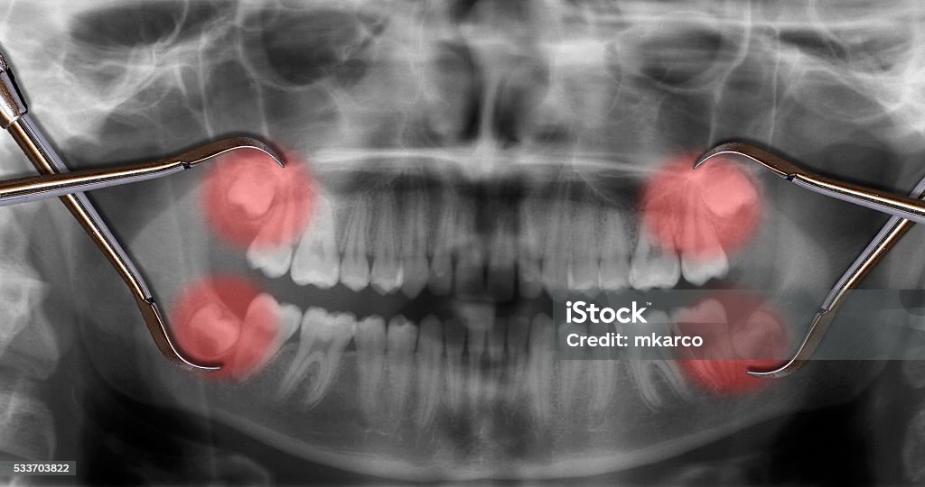display four wisdom teeth over x-ray Wisdom Stock Photo