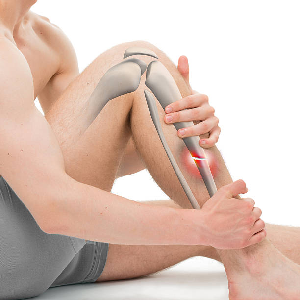 поперечный перелом tibia - перелом ноги 3d иллюстрация - tibia стоковые фото и изображения