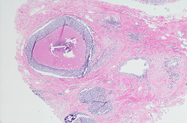 istock Ductal carcinoma (breast cancer) high grade. 533902214