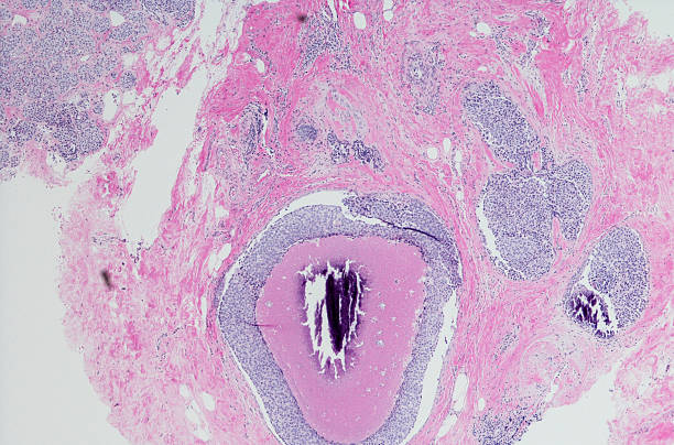 istock Ductal carcinoma (breast cancer) high grade. 533902240