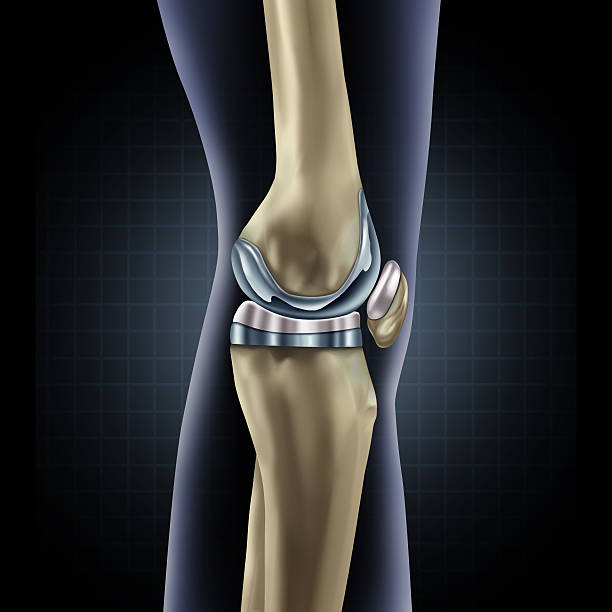 Knee Replacement Knee replacement implant medical concept as a human leg anatomy after a prosthetic surgery as a musculoskeletal disease treatment symbol for orthopedics with 3D illustration elements. artificial knee photos stock pictures, royalty-free photos & images