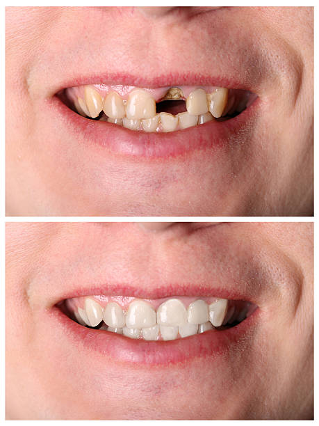 istock Incisive tooth restoration before and after treatment 533933439