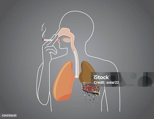 Human Burned Down Lung With Smoking Stock Illustration - Download Image Now - Smoking - Activity, Smoke - Physical Structure, Smoking Issues