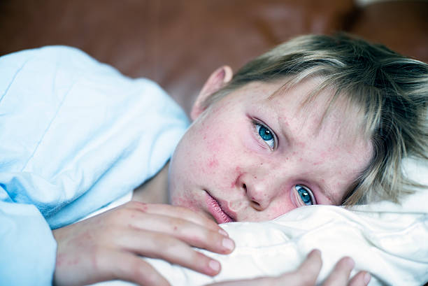 Measles Very sick 5 year old little boy fighting measles infection, boy is laying in bed under the blanket with a agonizing expression, boy is covered with rash caused by virus. measles stock pictures, royalty-free photos & images