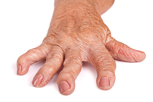 Medical: Rheumatoid Arthritis Hand stock photo