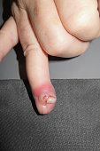 infizierten-finger-mit-pus-und-blut.jpg?b=1&s=170x170&k=20&c=TwZeU0Ko88jK3A8pfO-xM_Knskaw7fGTkgzbIZVdH5k=