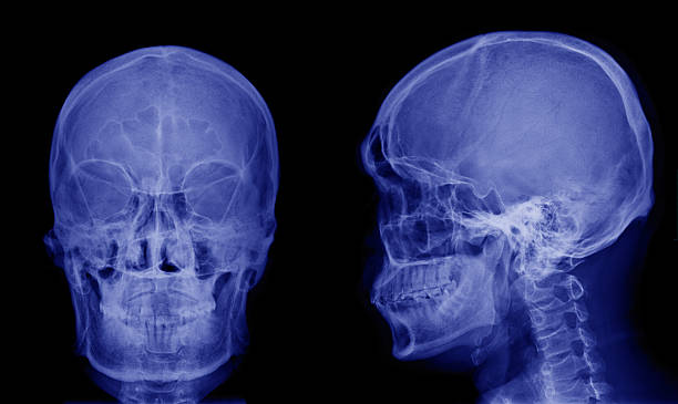 istock X-ray image of asian skull front view and side view 534217596