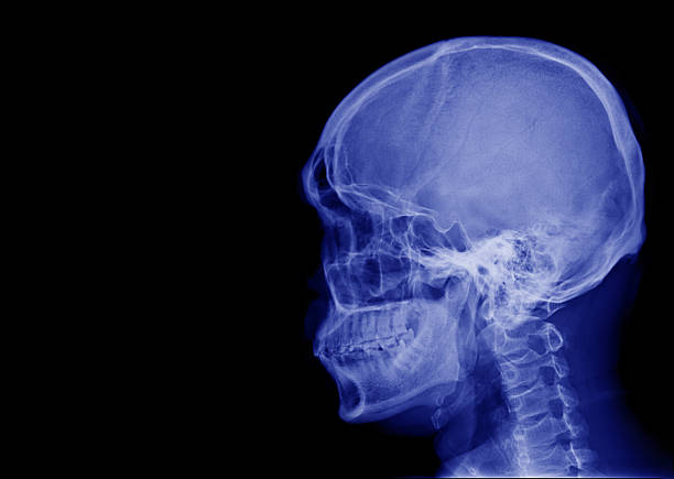 X-ray image of side view asian skull and blank area at left side