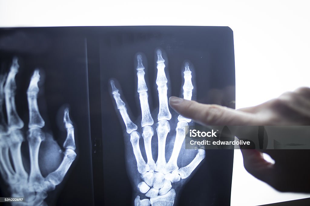 Medical doctor pointing at radiograph x-ray image Female medical doctor pointing with finger at radiograph x-ray image on viewing light screen monitor showing hand of patient in scan. Finding Stock Photo