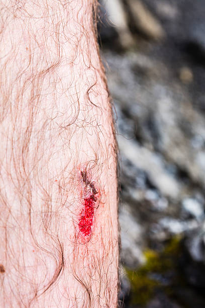 Wound on his leg. Unhealed wound on his leg after falling off eschar. eschar stock pictures, royalty-free photos & images