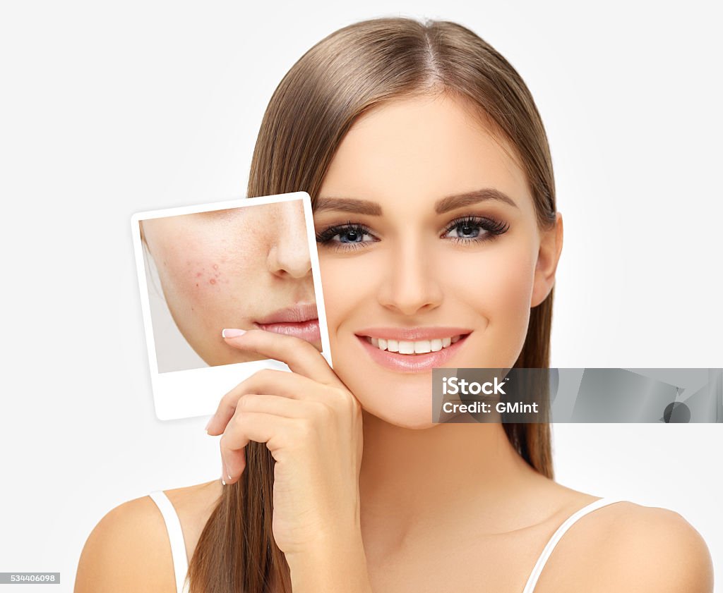 Jeune fille avec problème et purifier la peau. - Photo de Peau acnéique libre de droits