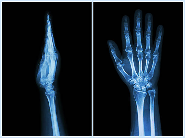 x-ray dłoni (& z przodu, widok z boku) - metacarpal zdjęcia i obrazy z banku zdjęć