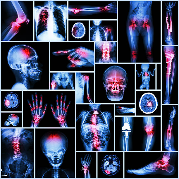 coleção raio-x parte do homem, ortopédico operação, várias doenças - cat scan pelvis hip human spine - fotografias e filmes do acervo